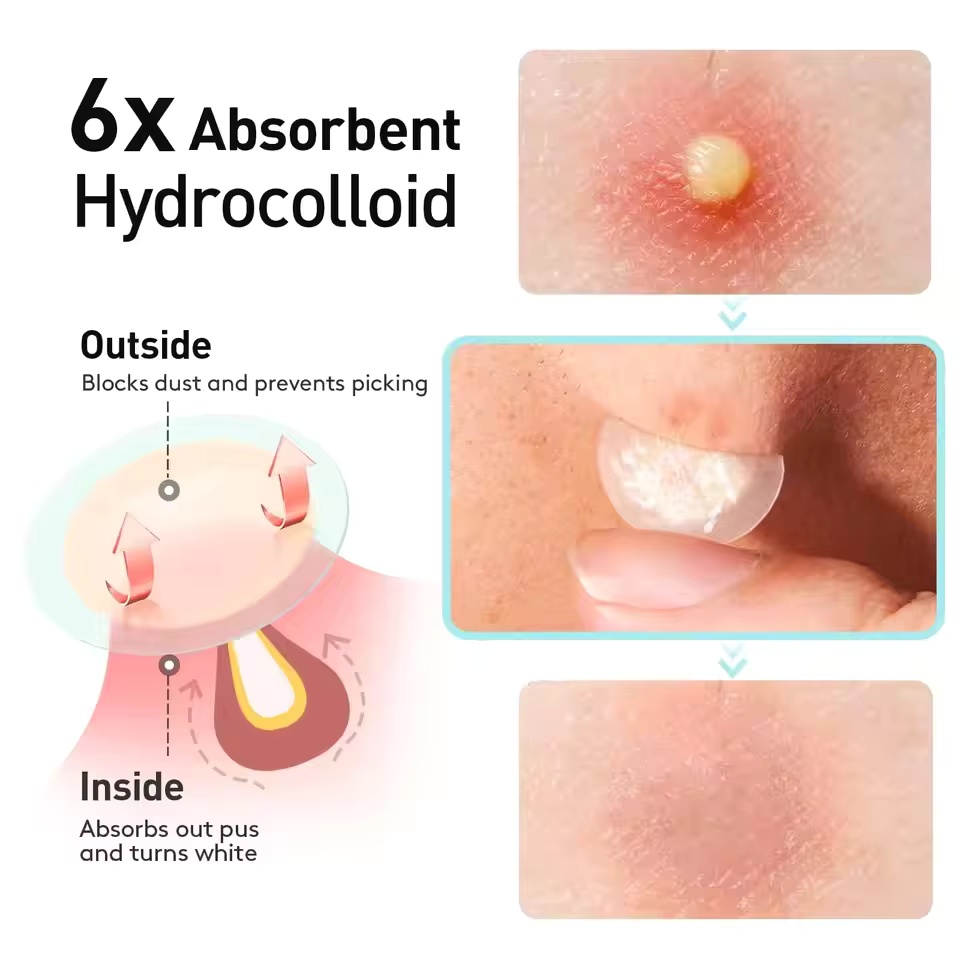 Patch per l'acne in gel a base - Skincare Basic recensione e prezzo
